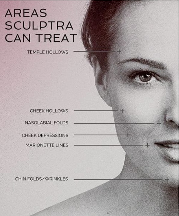 Sculptra treatment areas for facial aesthetics.