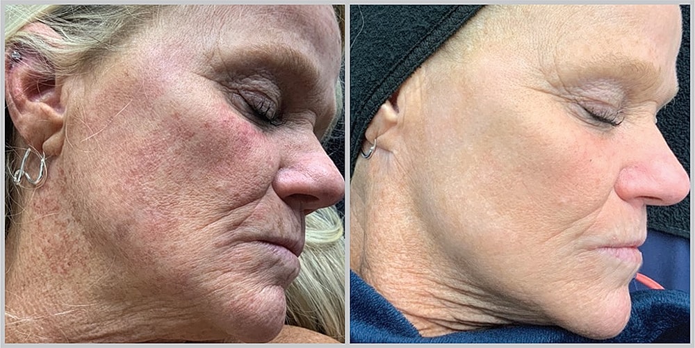 Before and after skin treatment comparison.