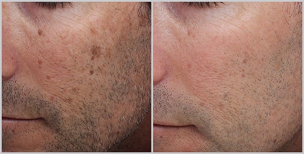 Before and after skin treatment comparison.
