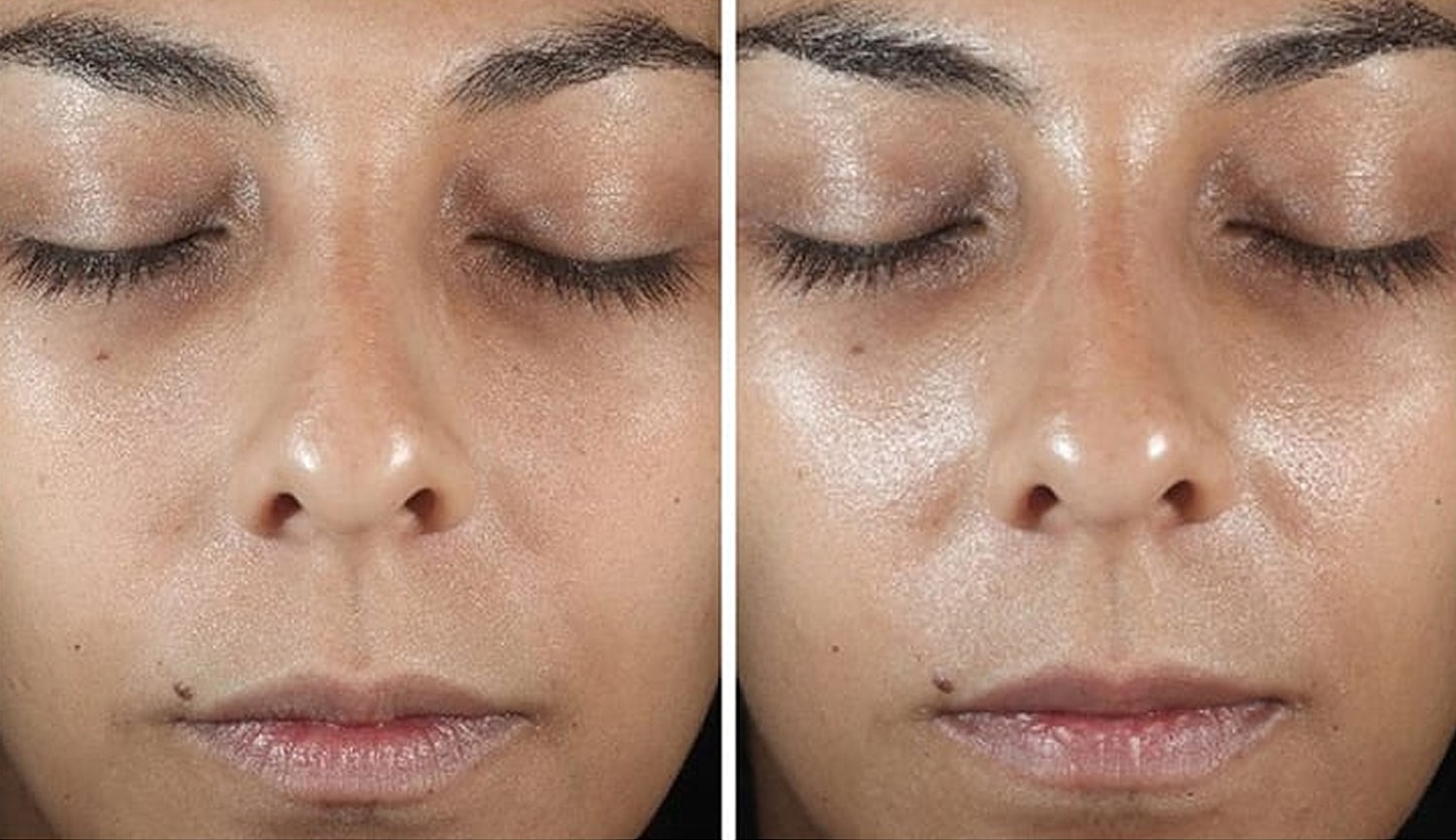 Comparison of skin texture before and after treatment