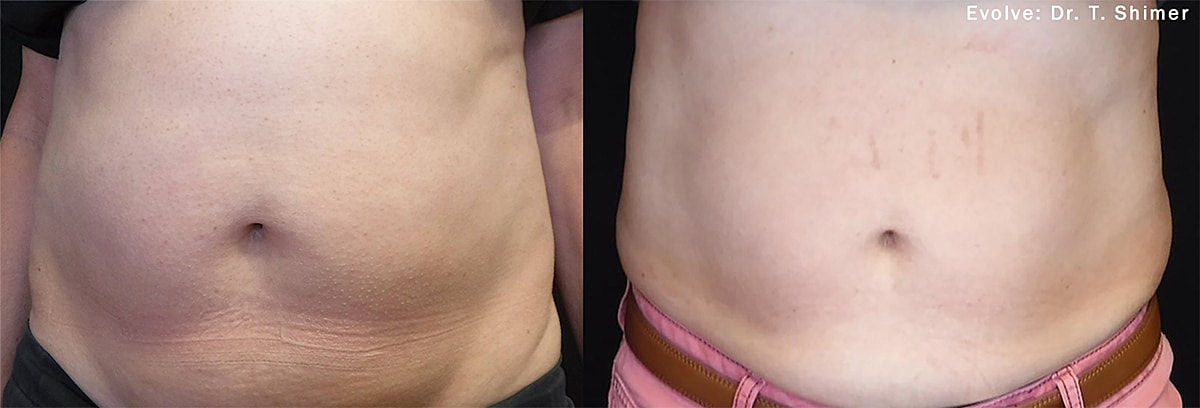 Before and after abdomen treatment comparison.