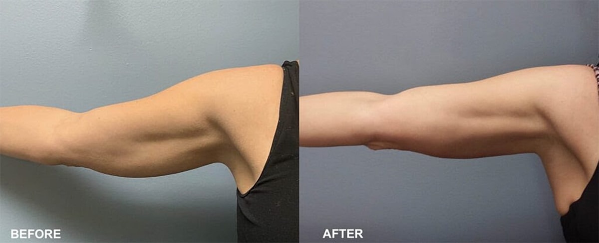 Before and after arm transformation comparison image