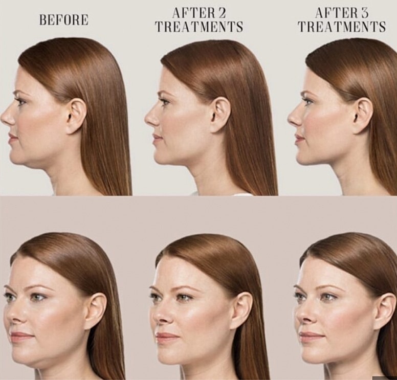 Before and after treatment progress comparison photo.