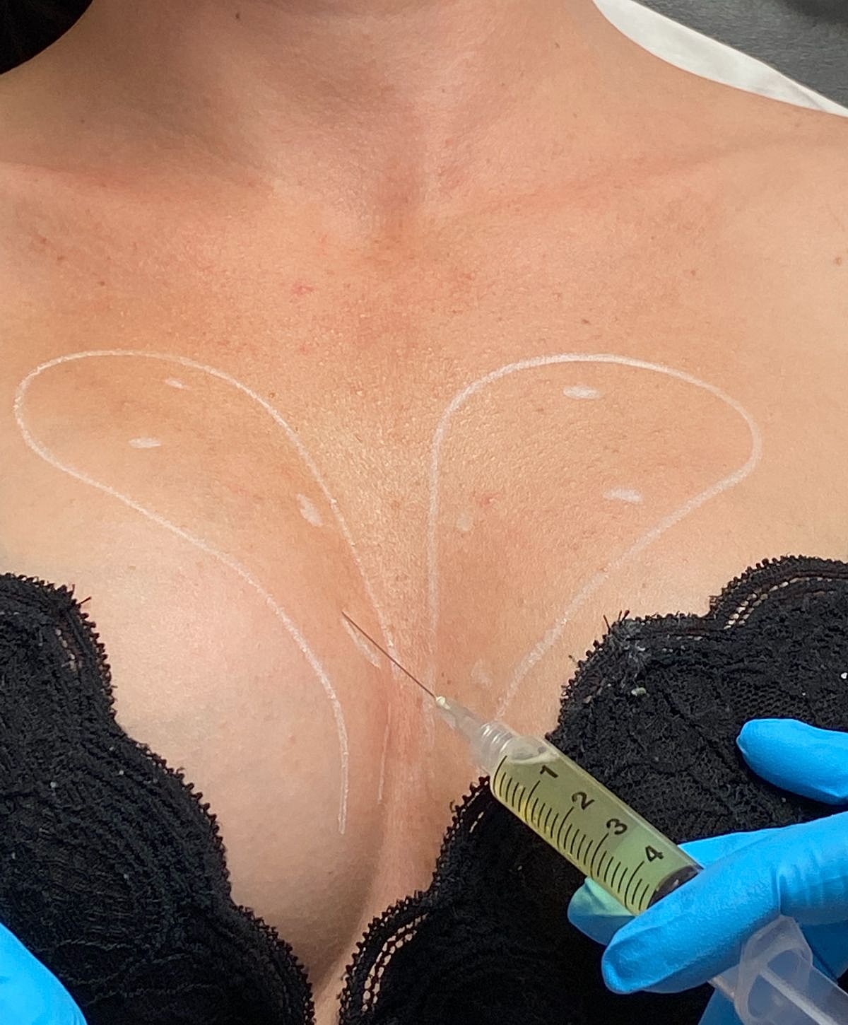 Injection procedure with marked skin areas.