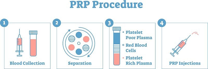 PRP procedure steps: Blood collection to injections.