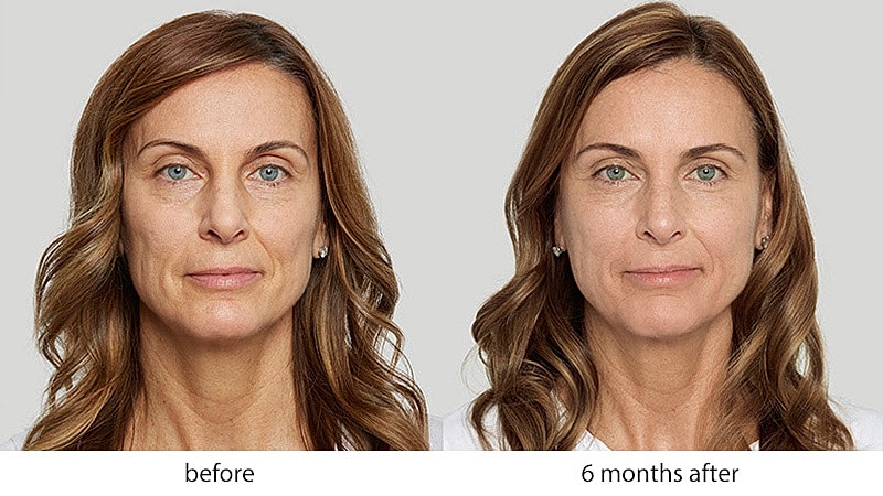Before and after skincare results comparison.
