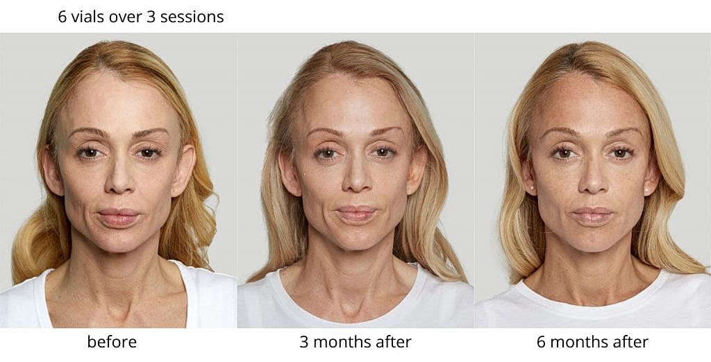 Transformation progress over six months following treatment