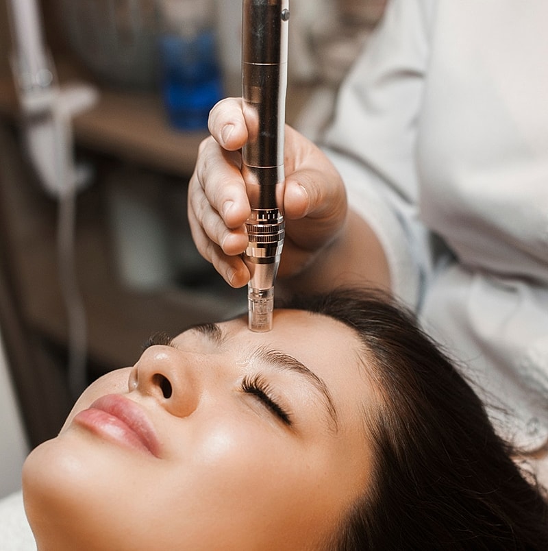 Microneedling facial treatment in progress.