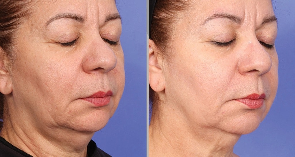 Before and after facial treatment comparison photo.