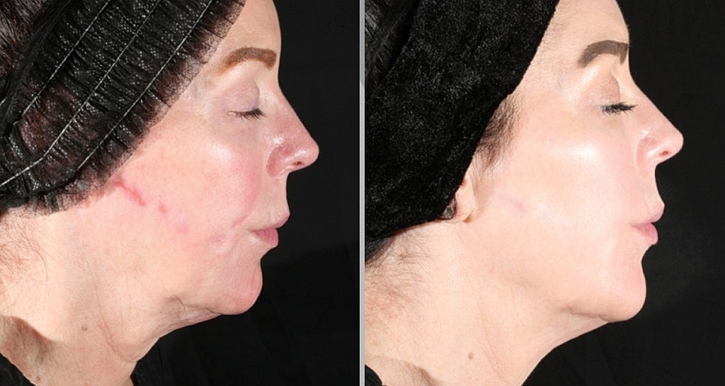 Before and after facial rejuvenation treatment comparison.