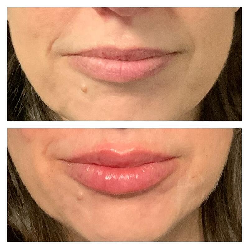 Lip Filler Before & After