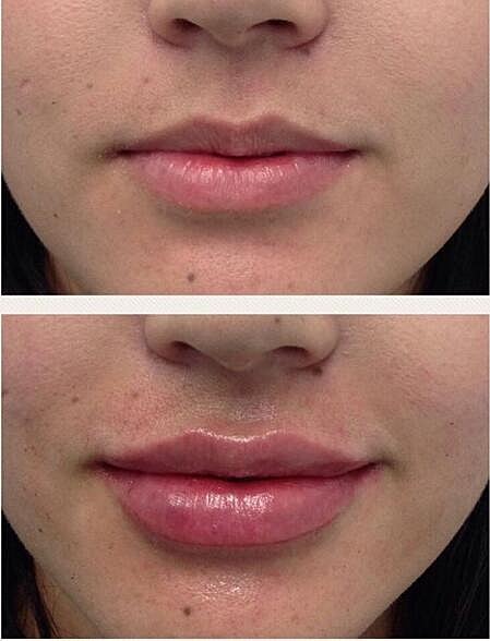 Lip Filler Before & After