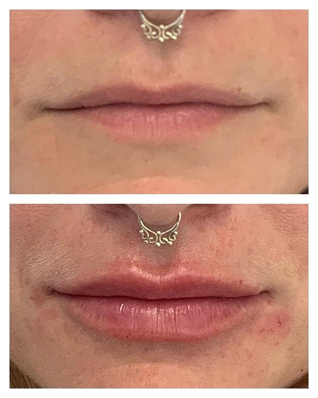 Lip Filler Before & After