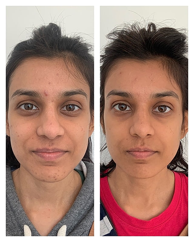 Prp Microneedling Before & After