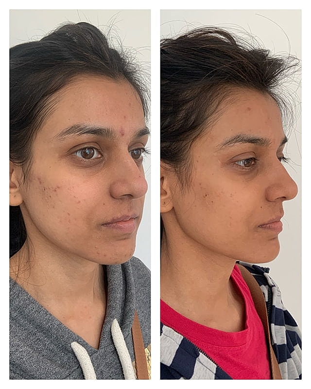 Prp Microneedling Before & After
