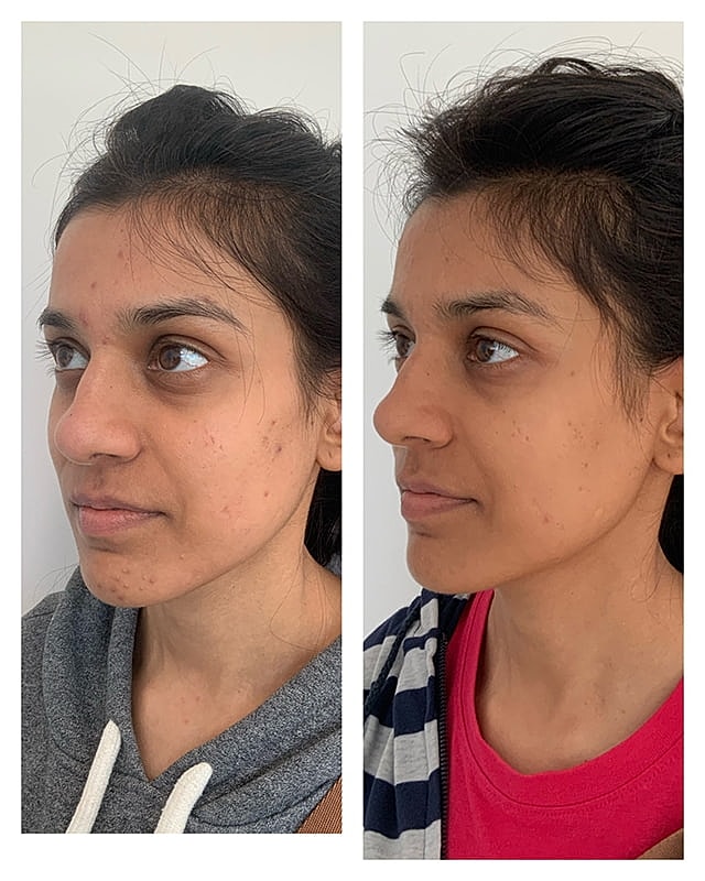 Prp Microneedling Before & After