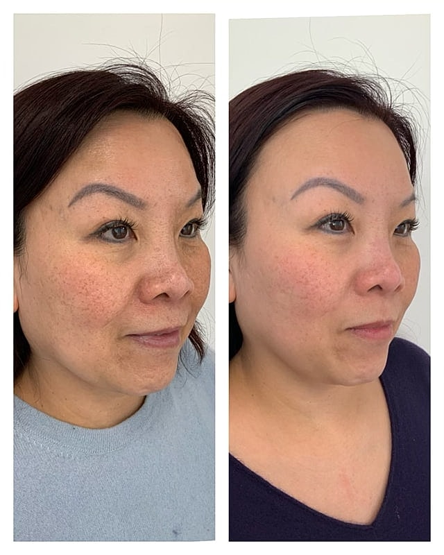 Prp Microneedling Before & After