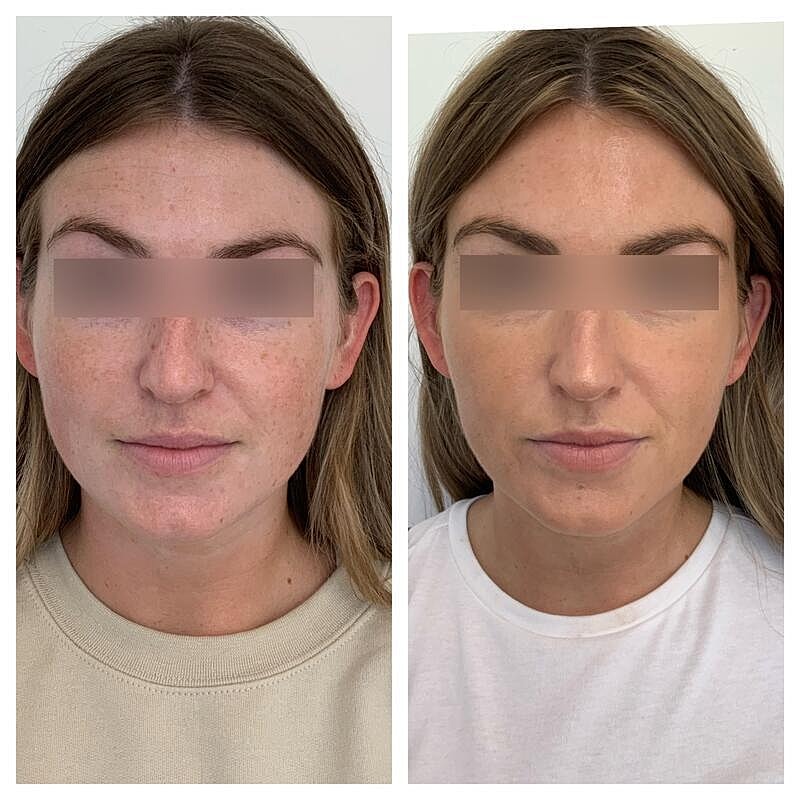 Botox Before & After