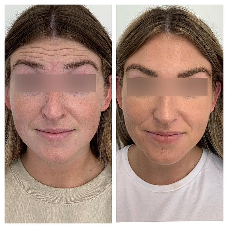 Botox Before & After