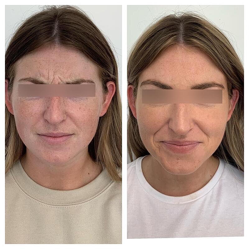 Botox Before & After