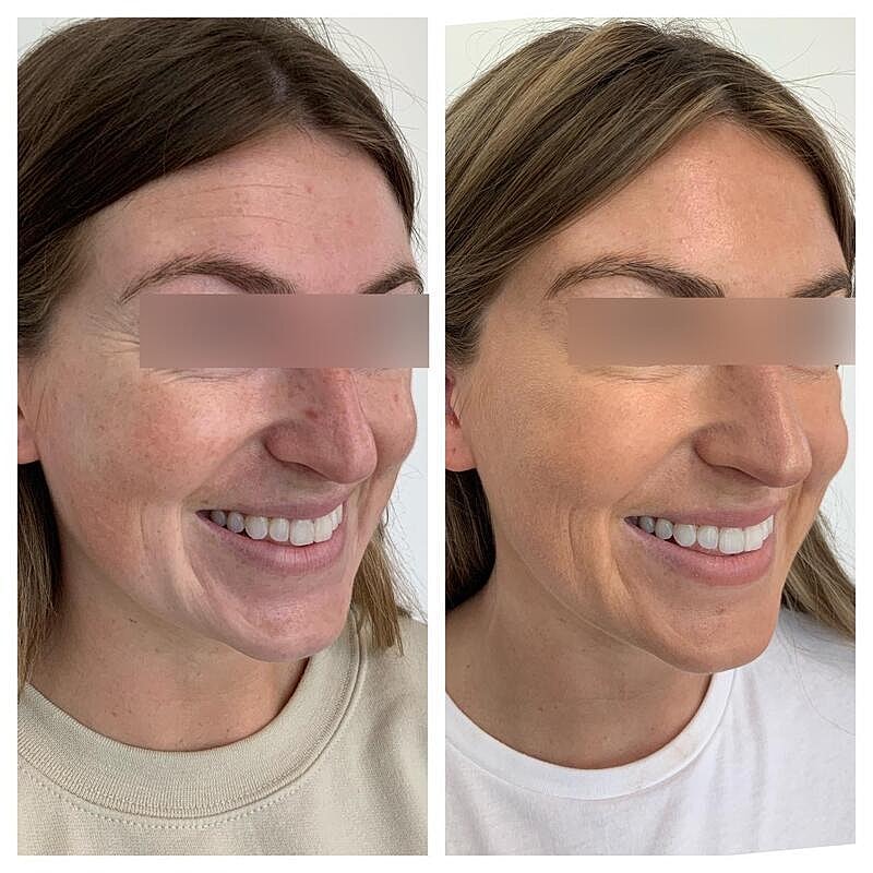 Botox Before & After