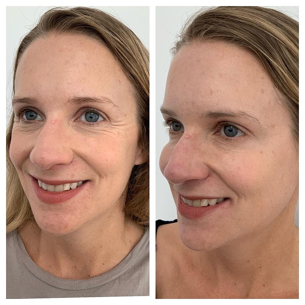 Botox Before & After
