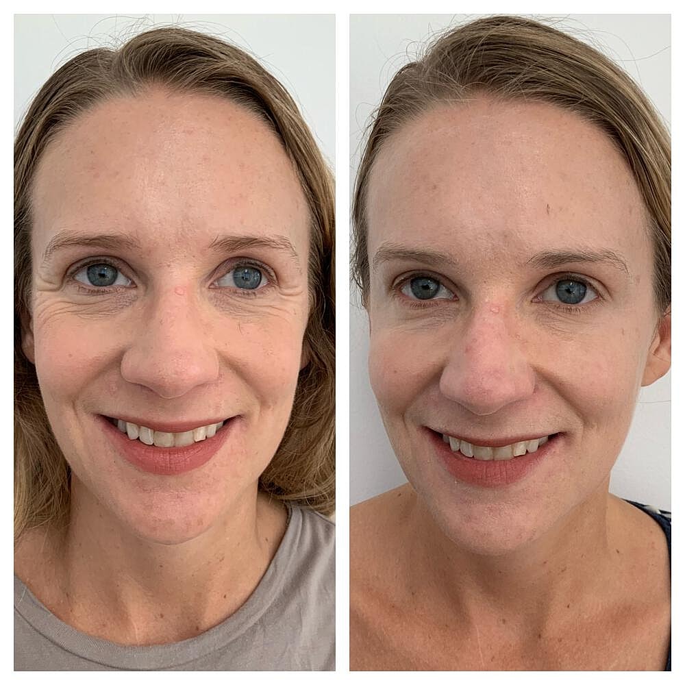 Botox Before & After