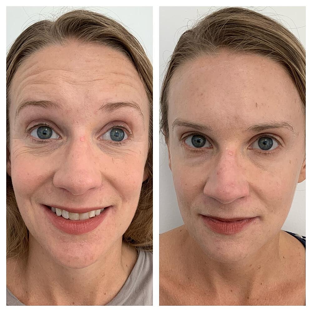 Botox Before & After