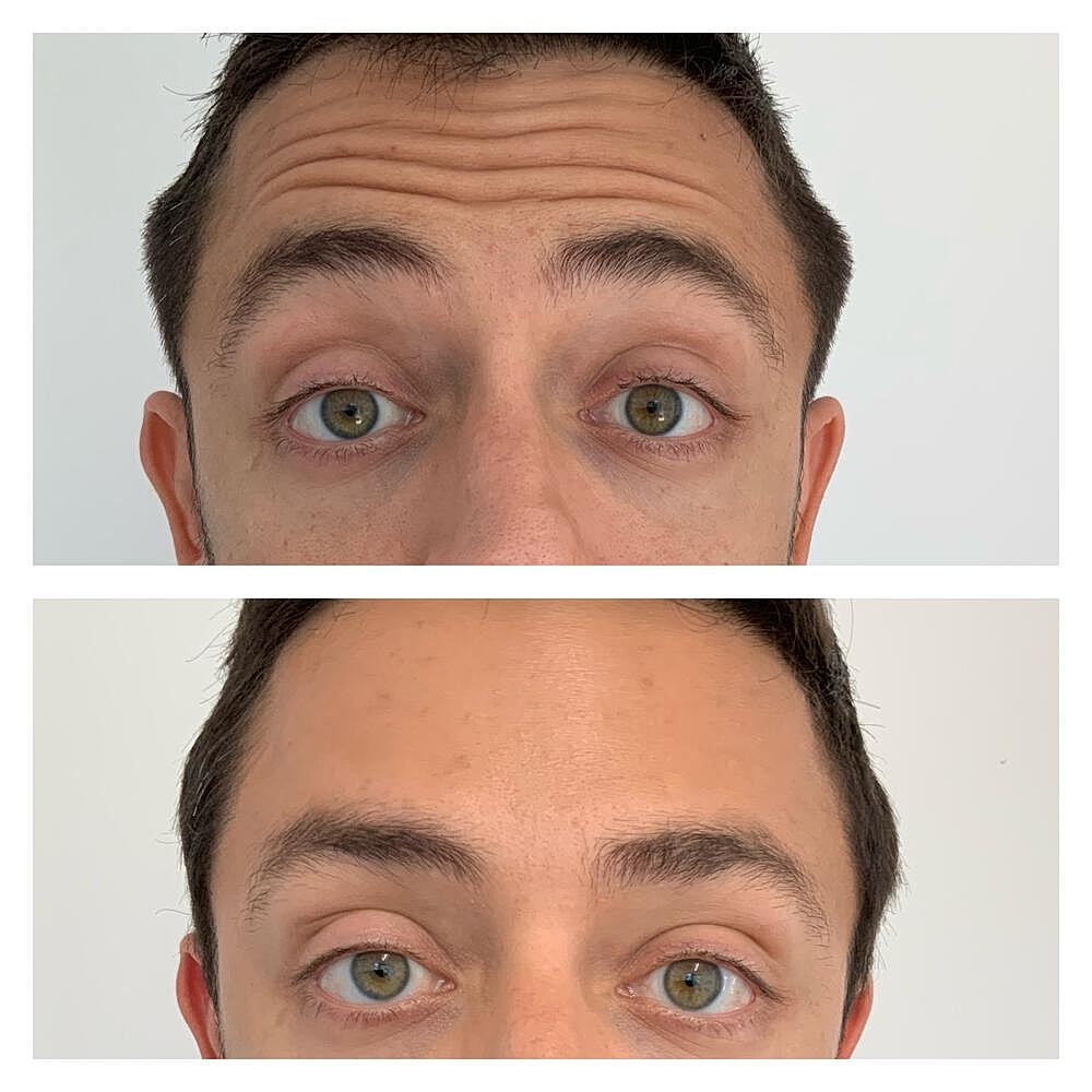 Botox Before & After
