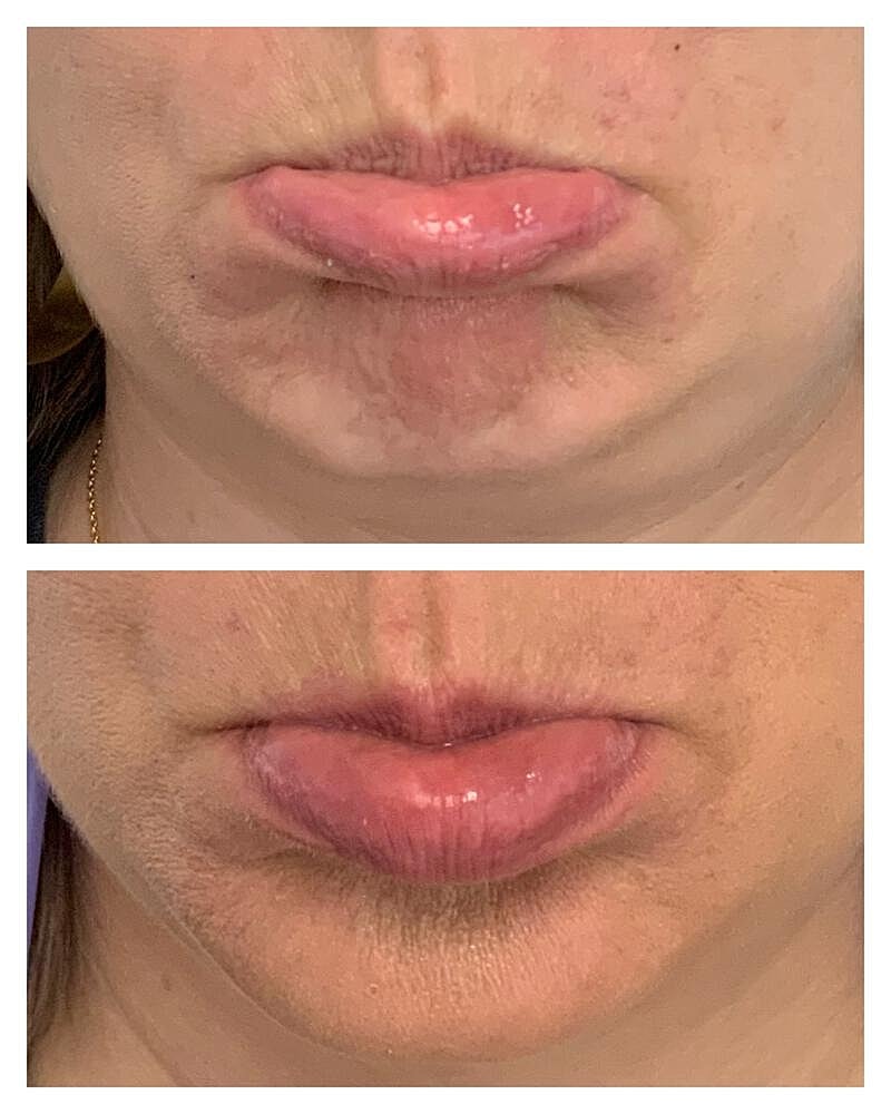 Botox Before & After