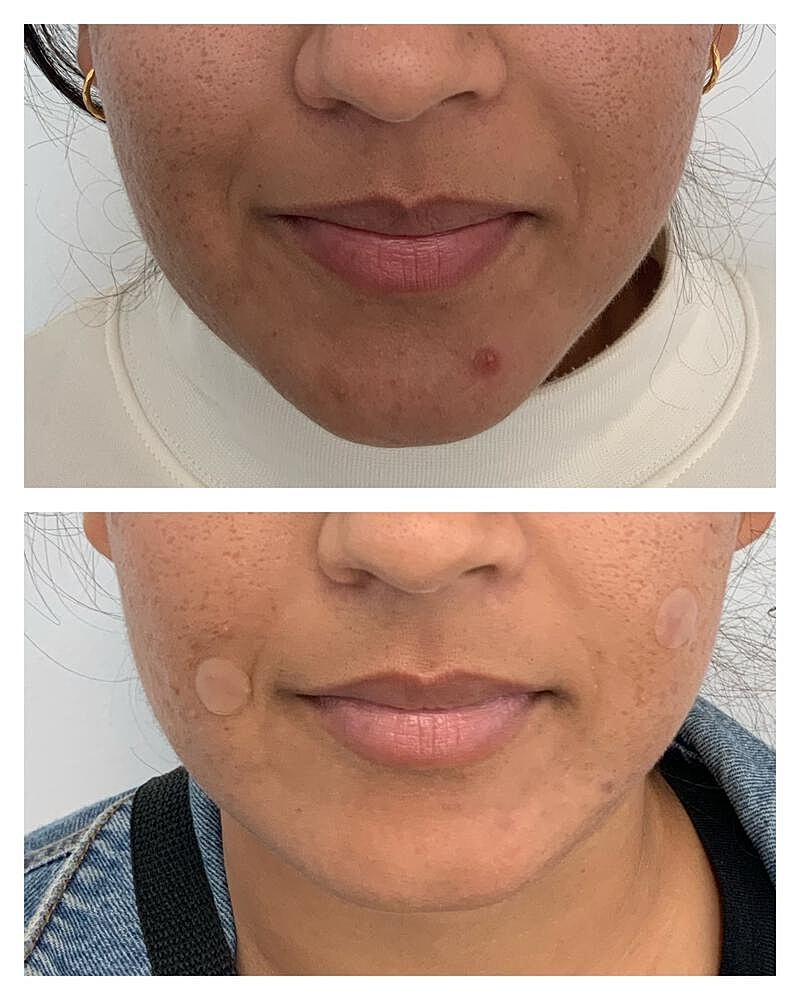 Botox Before & After