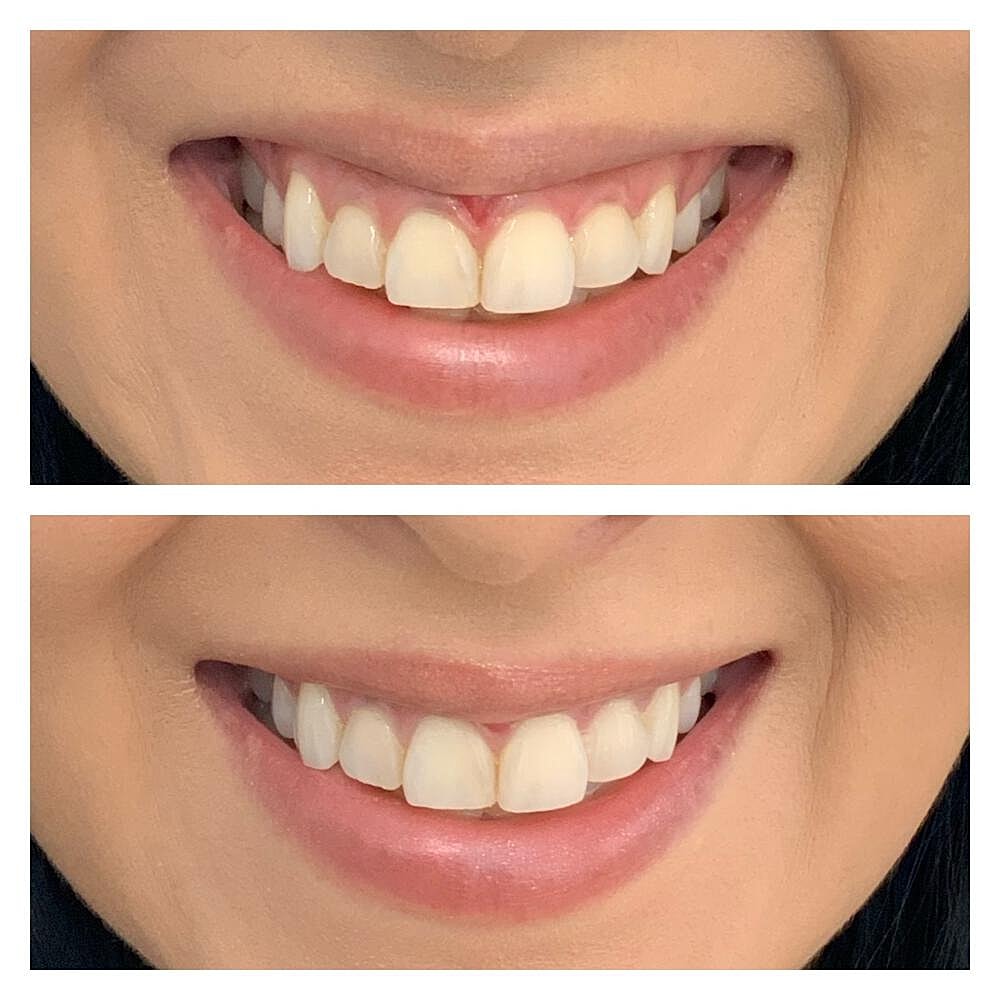 Botox Before & After