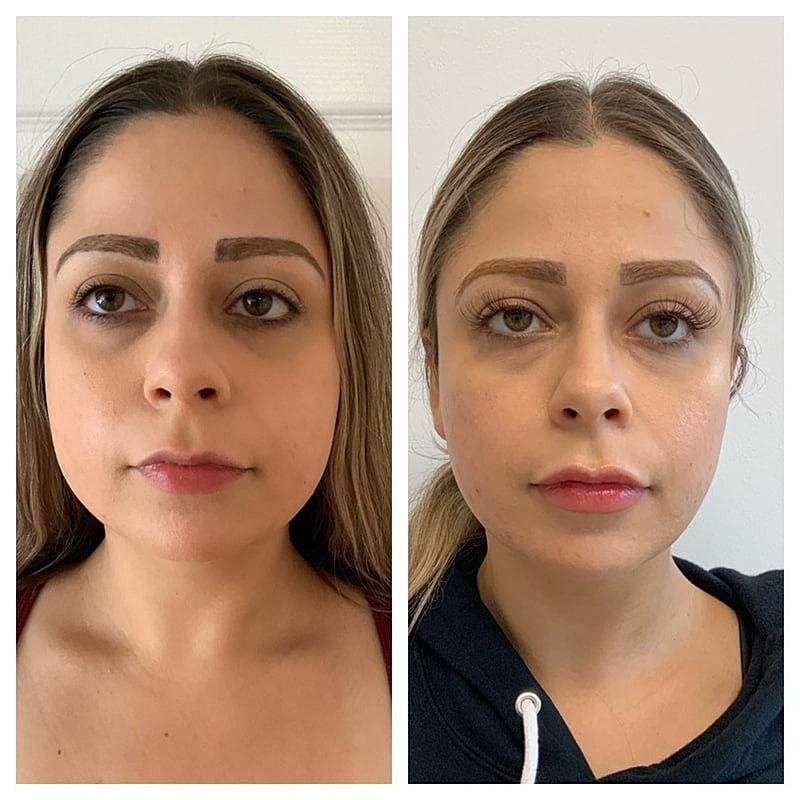 Botox Before & After