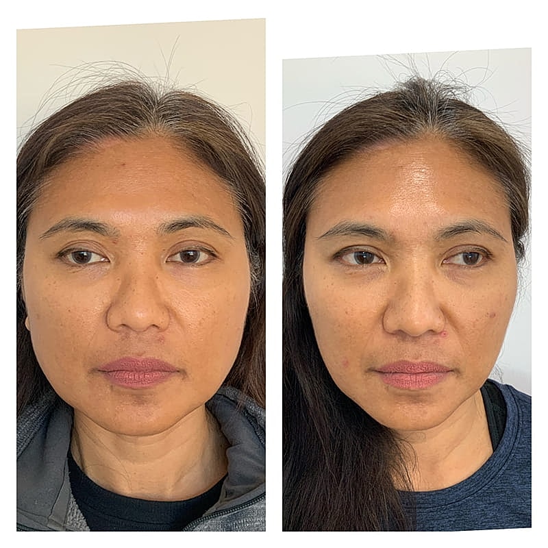 Botox Before & After