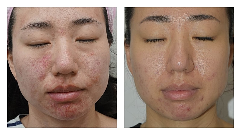 Potenza Rf Microneedling Before & After