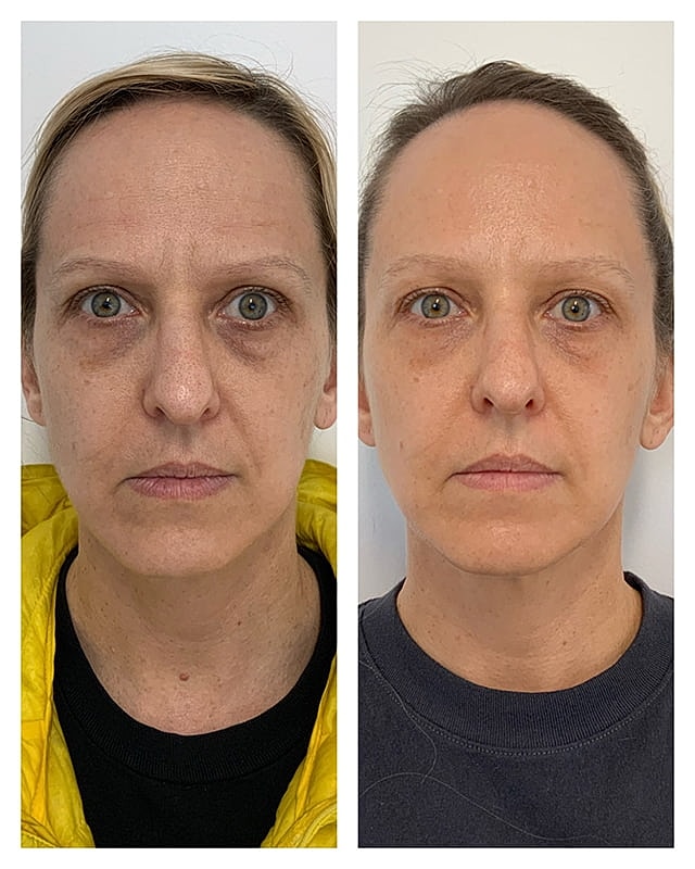 Ezprf Gel Before & After