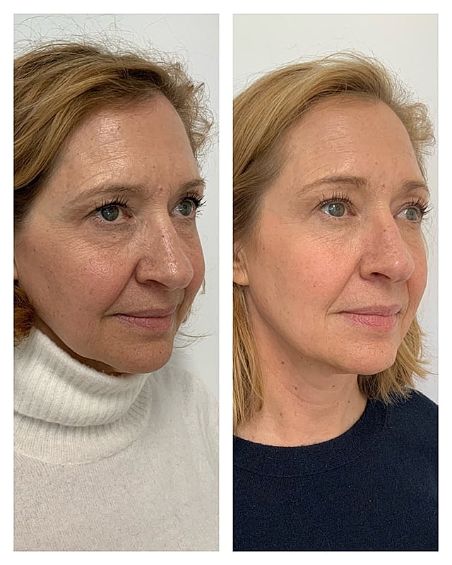 Sculptra Before & After