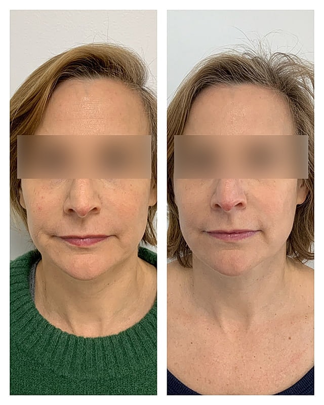 Sculptra Before & After