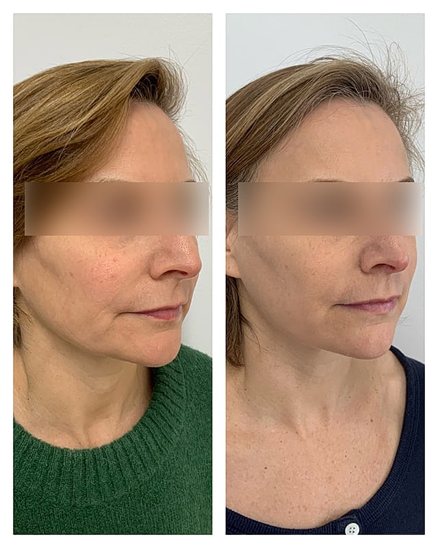 Sculptra Before & After