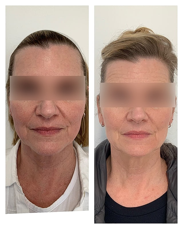 Sculptra Before & After