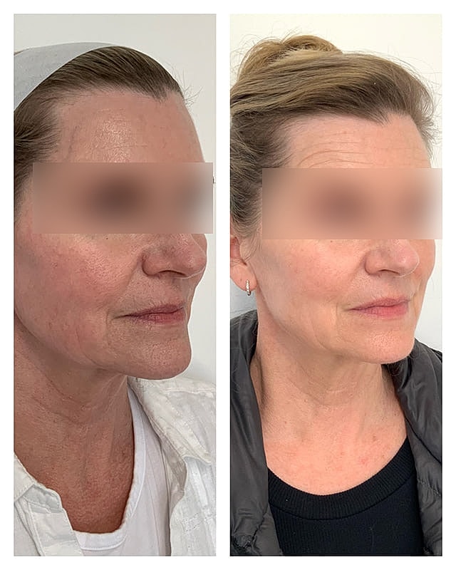 Sculptra Before & After