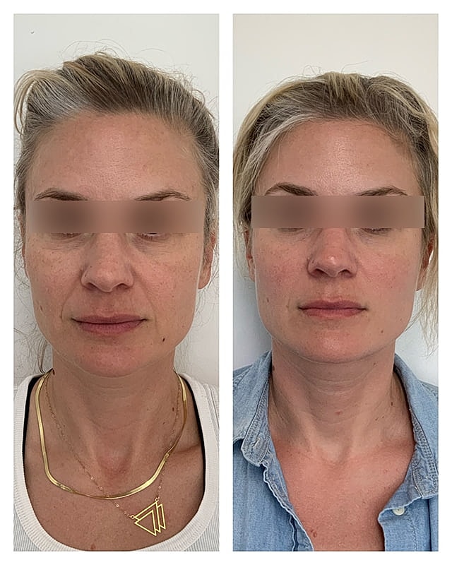 Sculptra Before & After