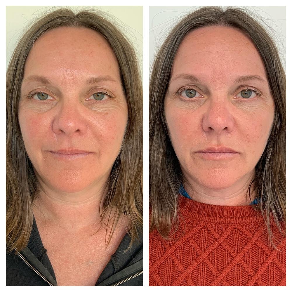 Dermal Filler Before & After
