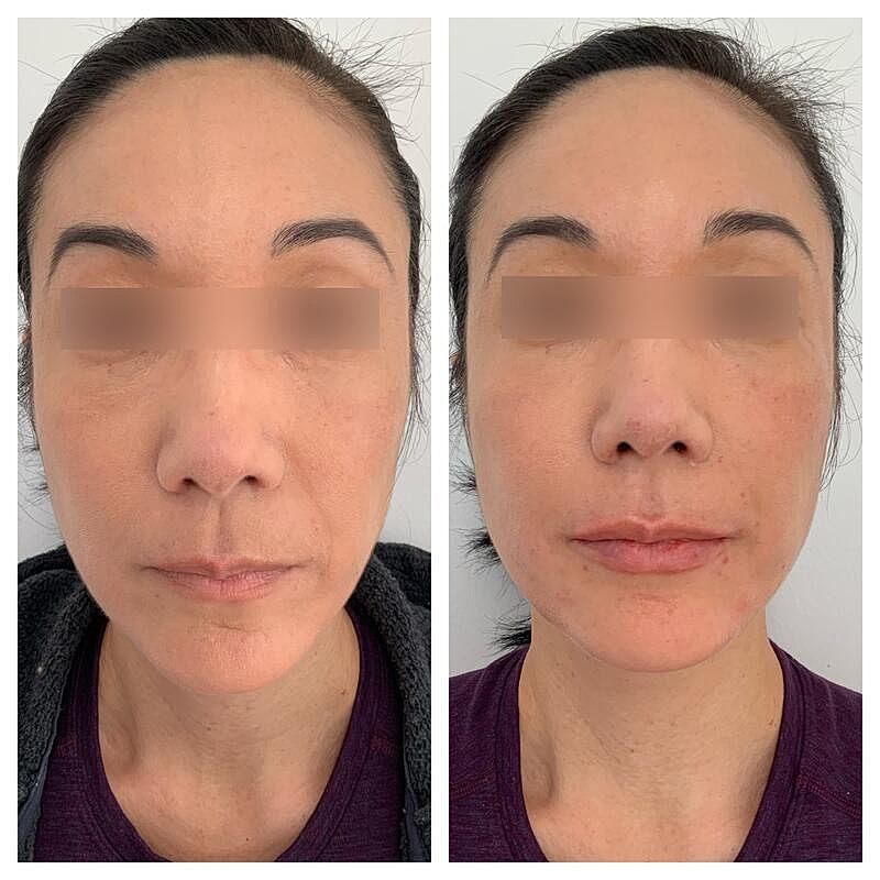Dermal Filler Before & After