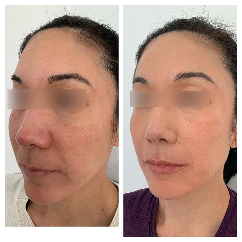 Dermal Filler Before & After
