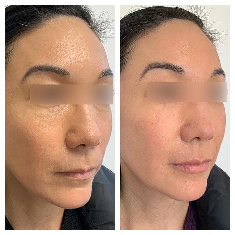 Dermal Filler Before & After