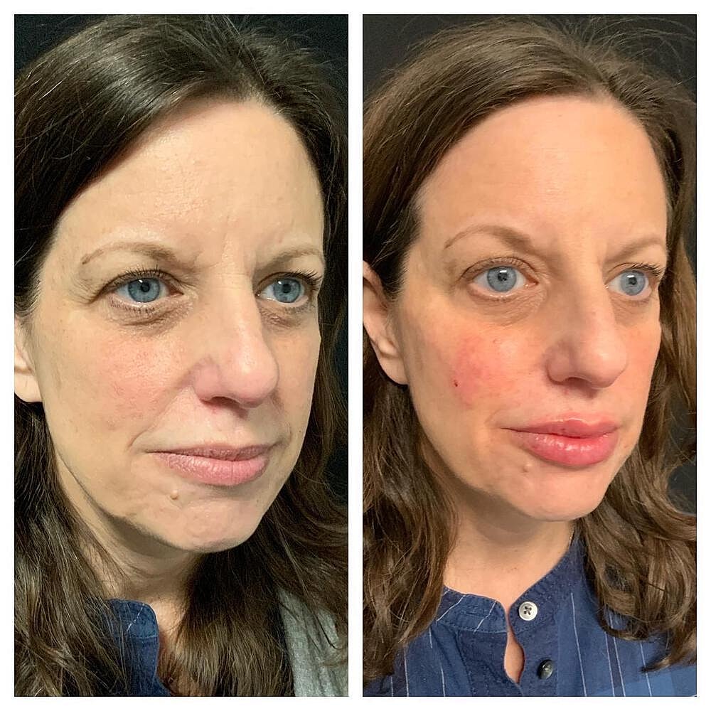 Dermal Filler Before & After