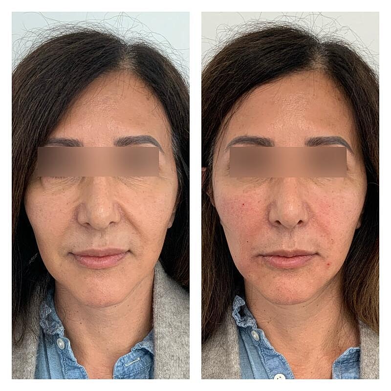Dermal Filler Before & After