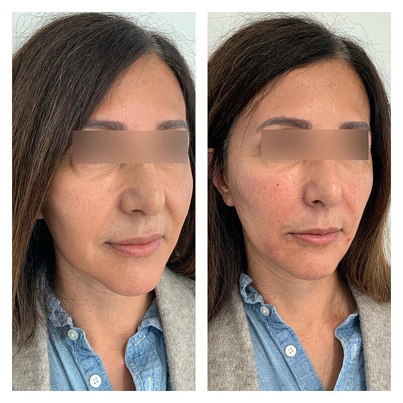 Dermal Filler Before & After