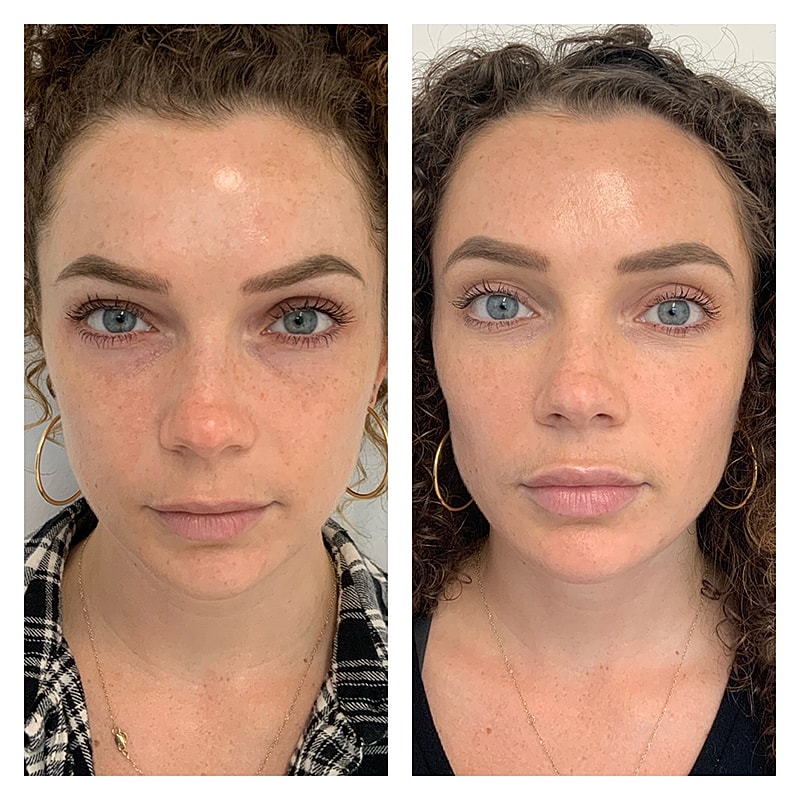 Dermal Filler Before & After